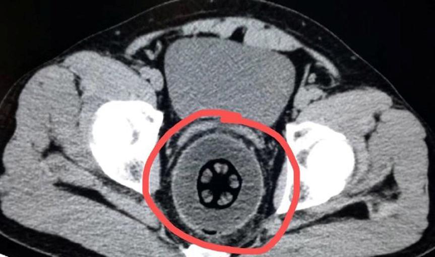 会玩！小伙直肠取出20厘米异物，称不小心塞入