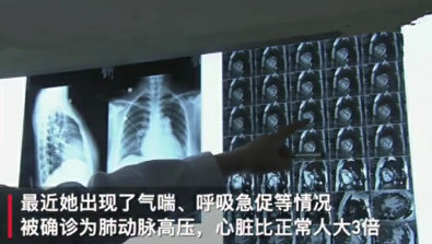 滥服减肥药心脏大常人3倍
