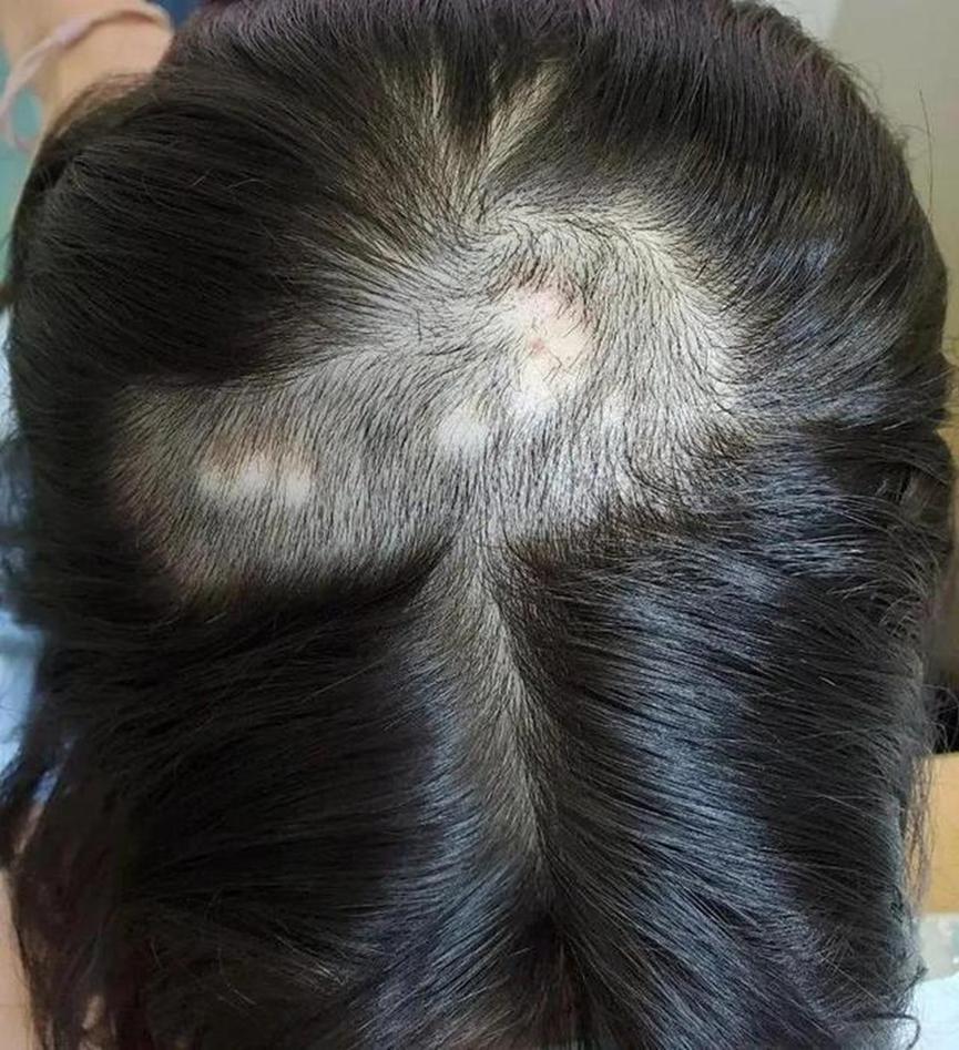 小学生头顶脱发，就医后确诊为斑秃，压力大是患病诱因