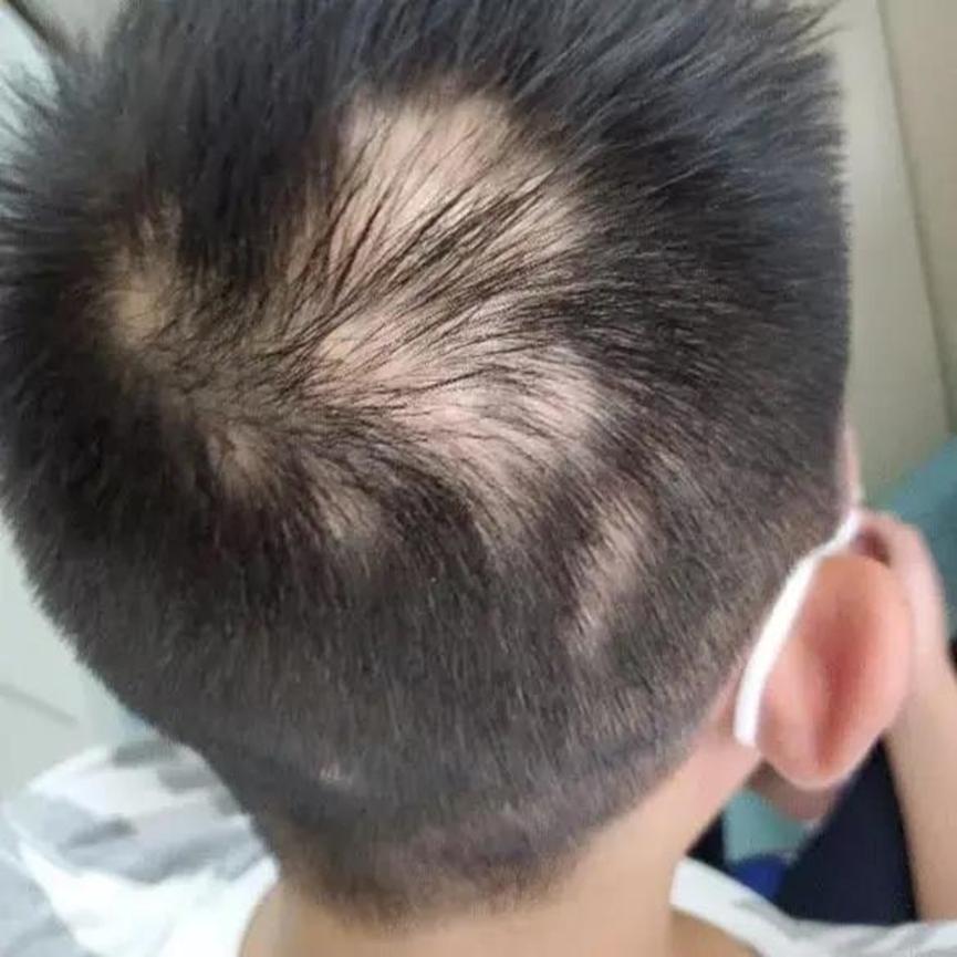 小学生头顶脱发，就医后确诊为斑秃，压力大是患病诱因