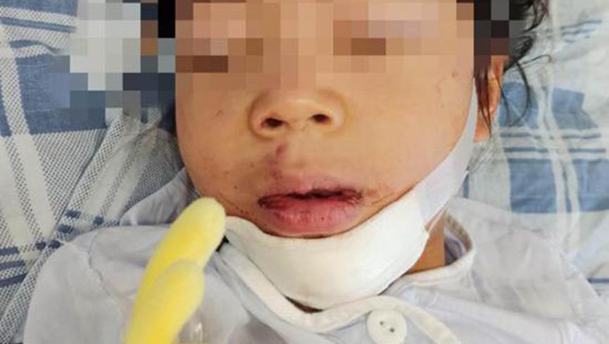 惊险！女童被老师反锁二楼教室坠楼，幼儿园商量赔偿出尔反尔