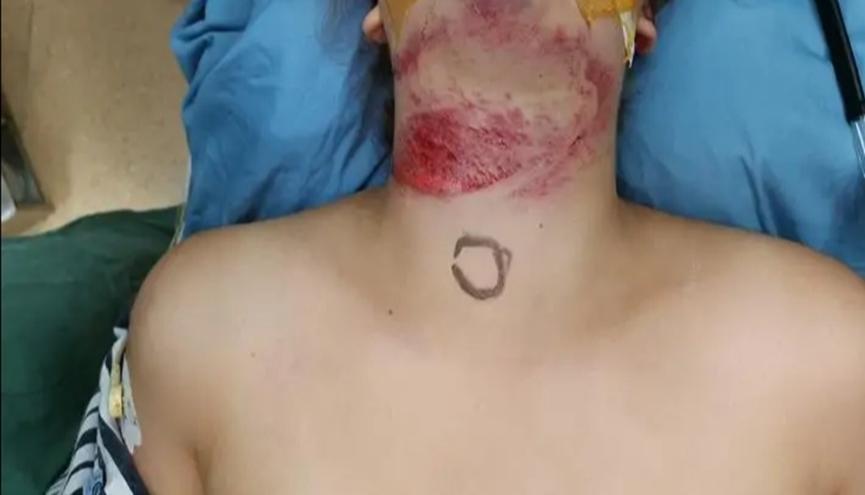 隐藏的绳子成“索命绳”，女子骑车被割，命悬一线